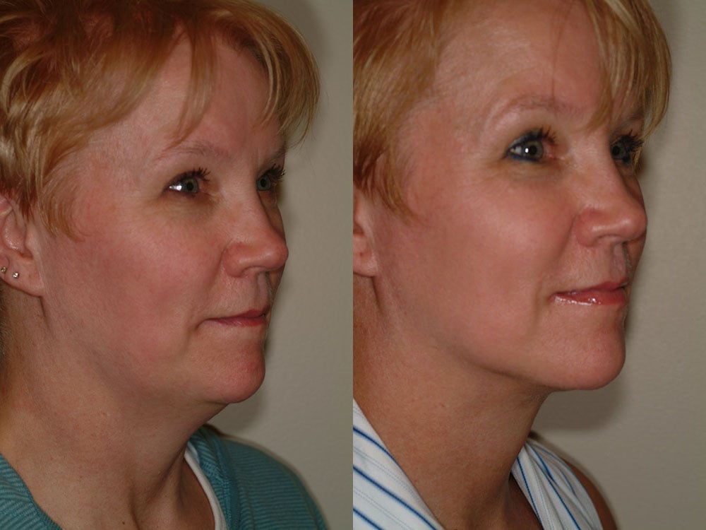 liposuction before and after photos by remington plastic surgery in kirkland wa