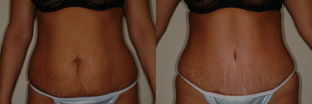 tummy tuck abdominoplasty before and after photos by remington plastic surgery in kirkland wa