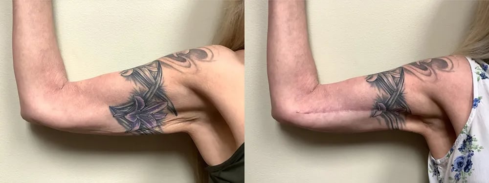 mh arm lift before and after photos by Remington Plastic Surgery in Kirkland WA