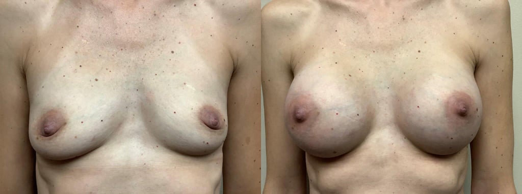 breast augmentation before and after photos by remington plastic surgery in kirkland wa