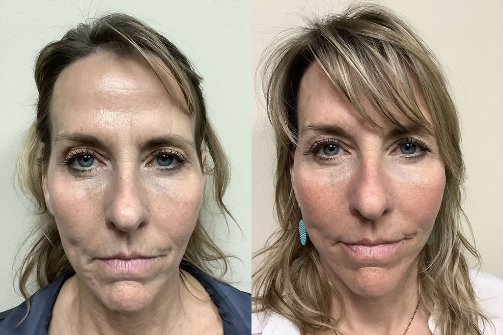face and neck lift before and after photos by remington plastic surgery in kirkland wa