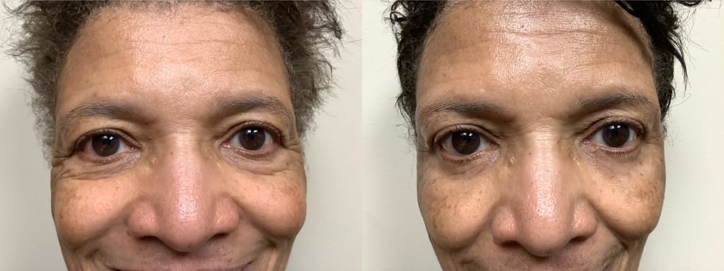 eyelid surgery before and after photos by remington plastic surgery in kirkland wa
