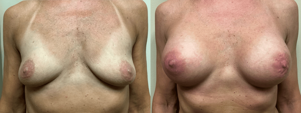 breast augmentation before and after photos by remington plastic surgery in kirkland wa