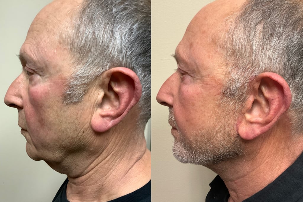 face and neck lift before and after photos by remington plastic surgery in kirkland wa