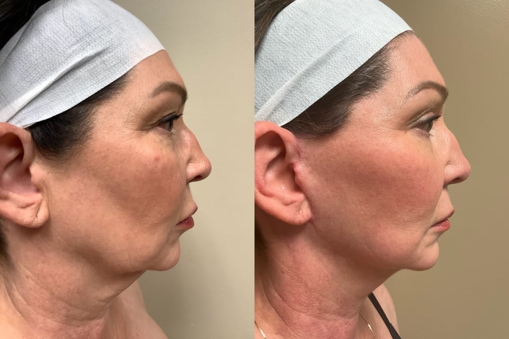 face and neck lift before and after photos by remington plastic surgery in kirkland wa