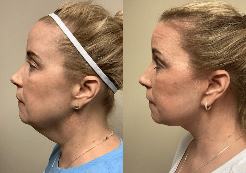 face and neck lift before and after photos by remington plastic surgery in kirkland wa