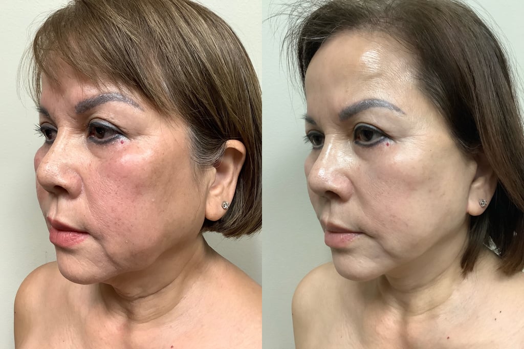 face and neck lift before and after photos by remington plastic surgery in kirkland wa