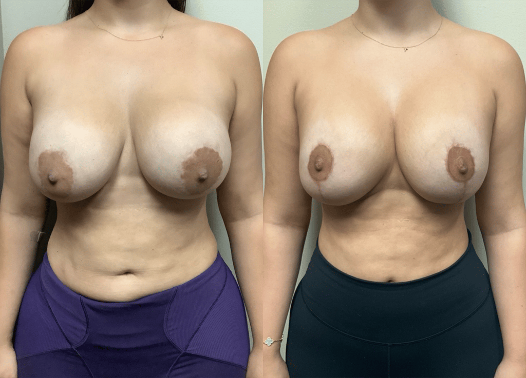 breast implant revision before and after photos by remington plastic surgery in kirkland wa
