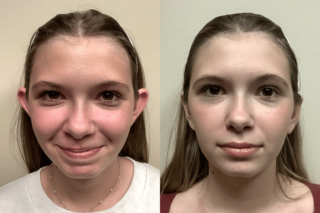 ear surgery before and after photos by remington plastic surgery in kirkland wa