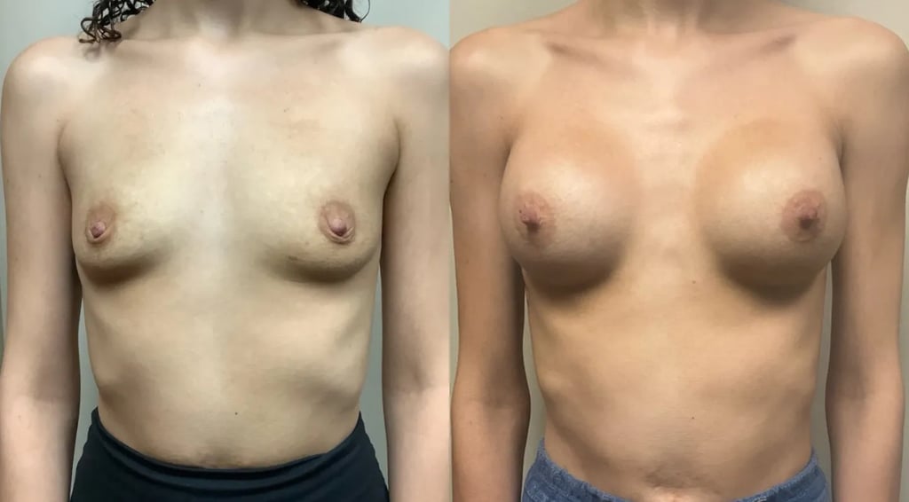 front view breast augmentation before and after photos by Remington Plastic Surgery