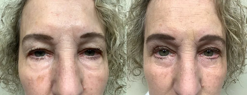 eyelid surgery before and after photos by Remington Plastic Surgery in Kirkland WA