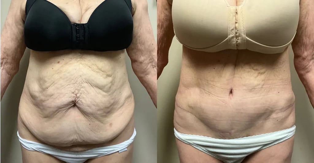 tummy tuck before and after photos by Remington Plastic Surgery in Kirkland WA