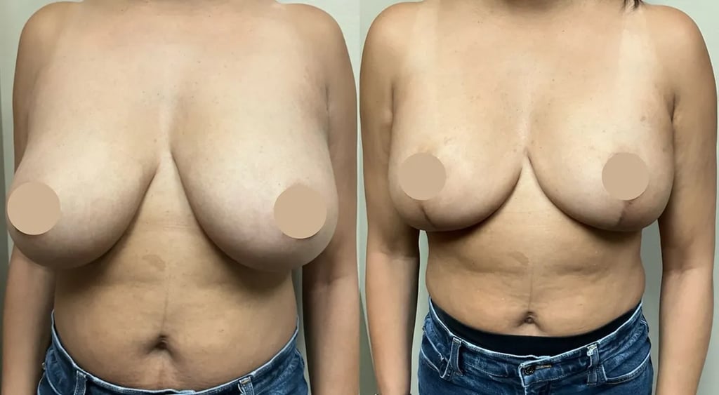 breast reduction before and after photos by Remington Plastic Surgery in Kirkland WA