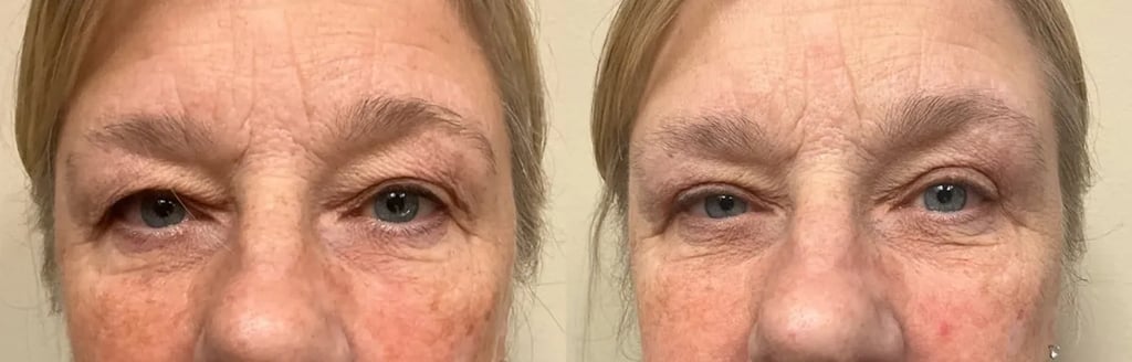 eyelid surgery before and after photos by Remington Plastic Surgery in Kirkland WA