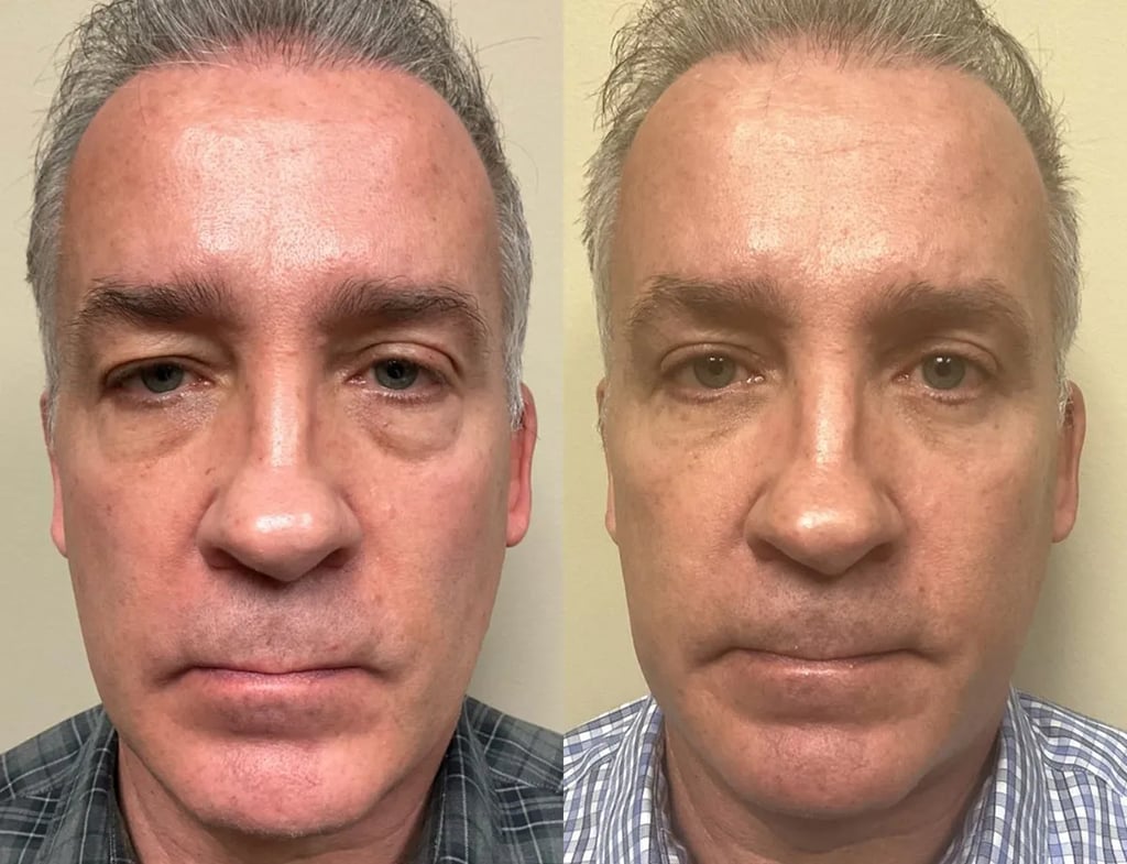 bm eyelid surgery before and after photos by Remington Plastic Surgery in Kirkland WA