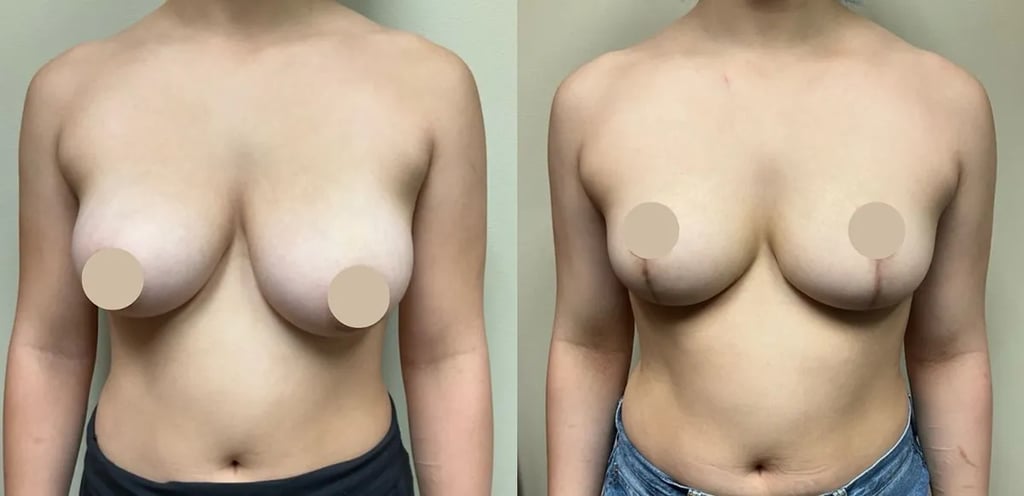 gc breast reduction before and after photos by Remington Plastic Surgery in Kirkland WA