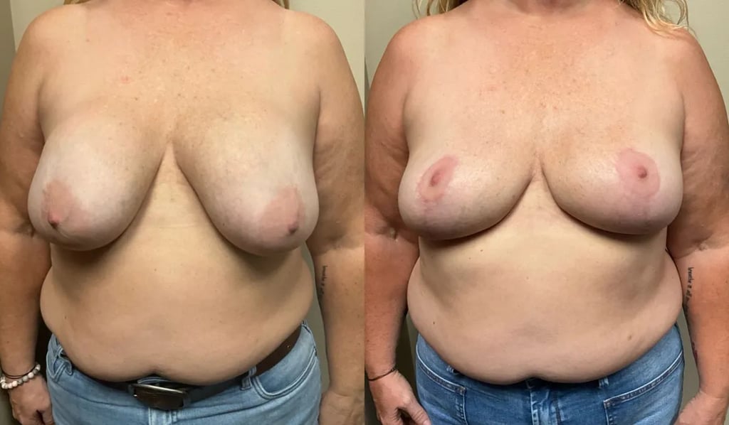 tb breast implant removal before and after photos by Remington Plastic Surgery in Kirkland WA