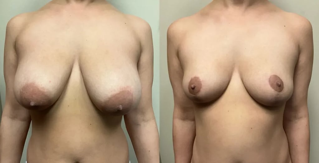 breast reduction before and after photos by Remington Plastic Surgery in Kirkland WA