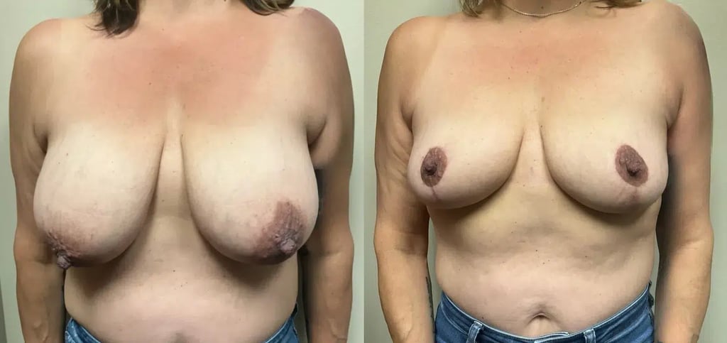 front view breast reduction before and after photos by Remington Plastic Surgery