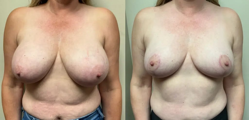 front view breast reduction before and after photos by Remington Plastic Surgery MPP