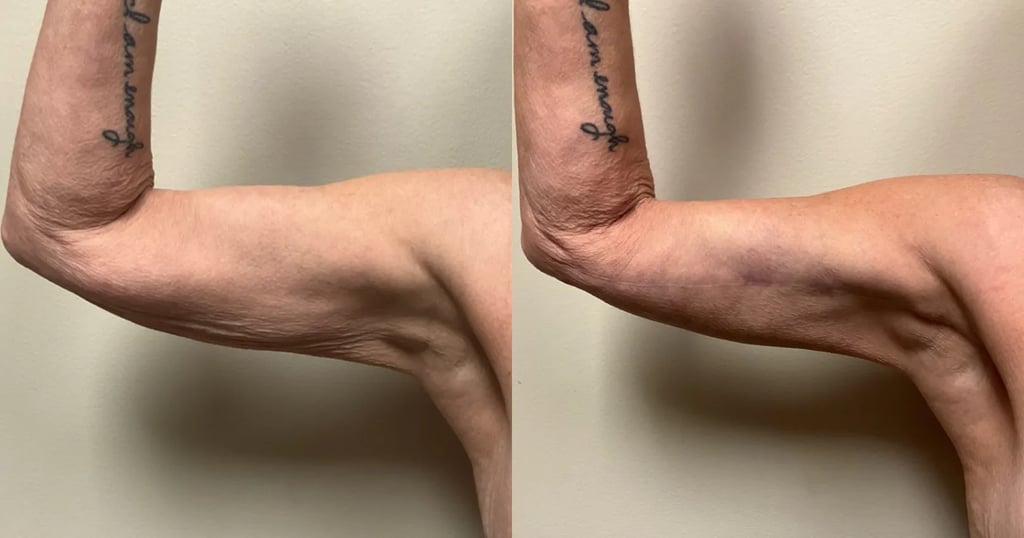 left side view breast reduction before and after photos by Remington Plastic Surgery