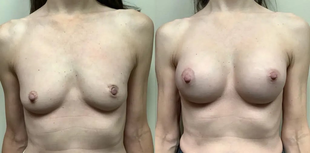front view breast augmentation before and after photos by Remington Plastic Surgery KL