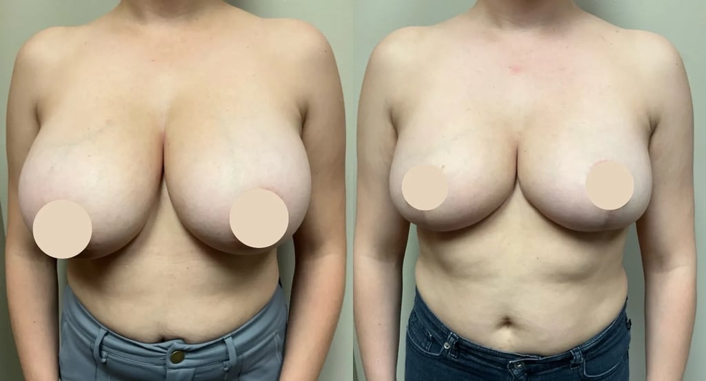 front view breast reduction before and after photos by Remington Plastic Surgery SR