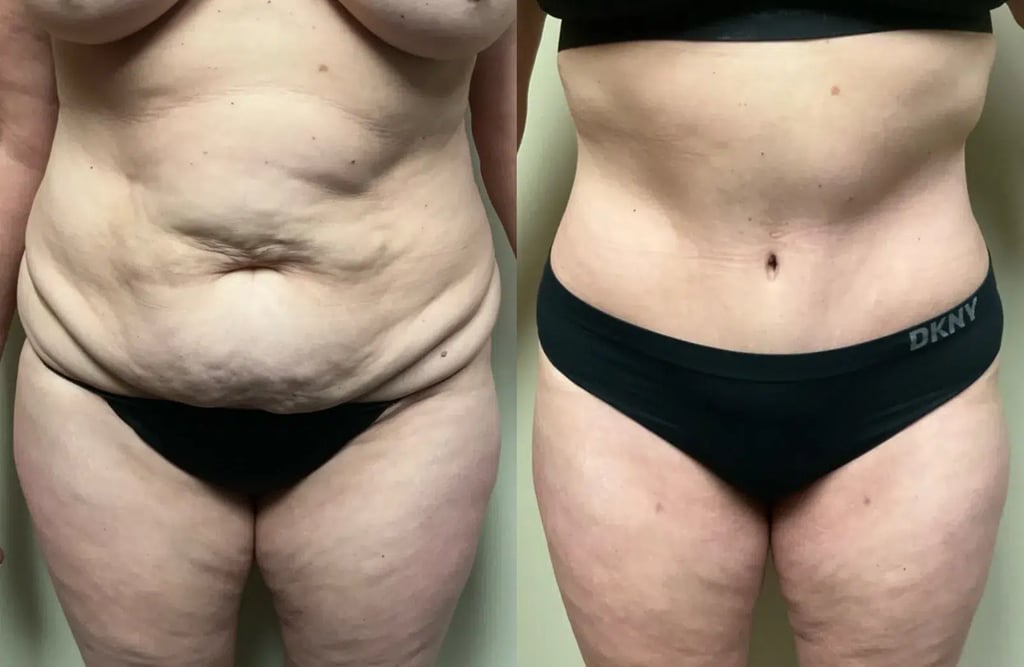 close up view abdominoplasty before and after photos by Remington Plastic Surgery CE