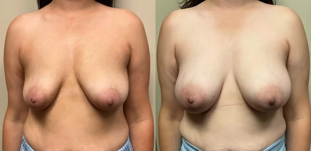 fornt view breast augmentation before and after photos by Remington Plastic Surgery DC