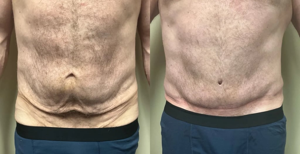 front view abdominoplasty before and after photos by Remington Plastic Surgery BF
