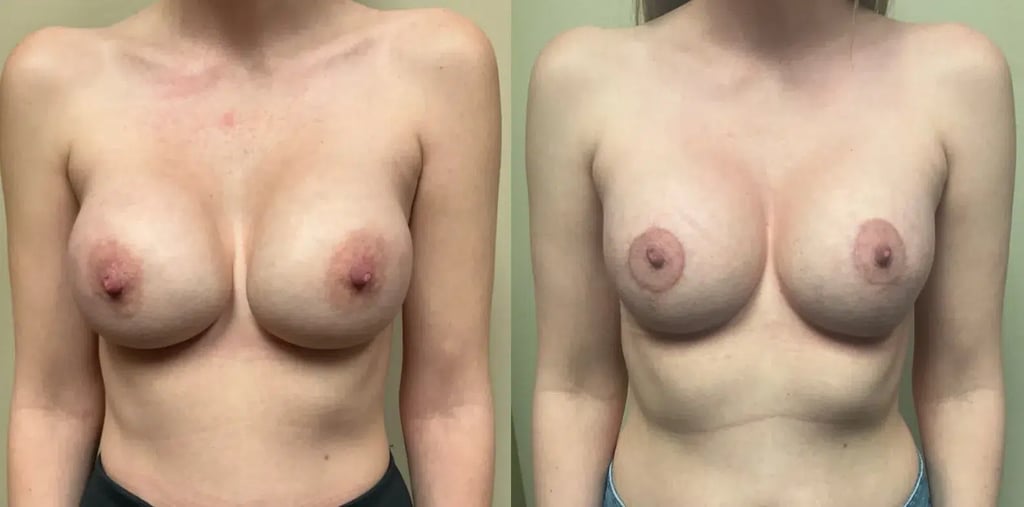 front view breast implant revision before and after photos by Remington Plastic Surgery TS
