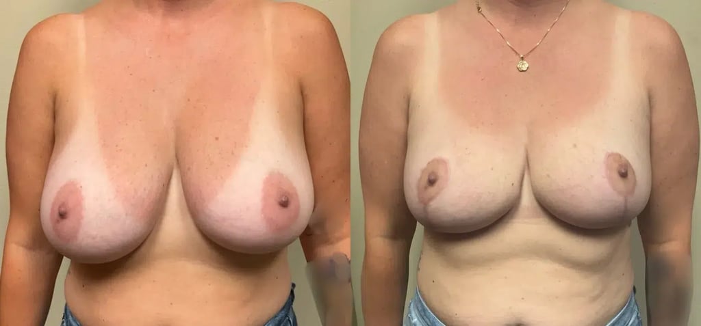 front view breast reduction before and after photos by Remington Plastic Surgery TB