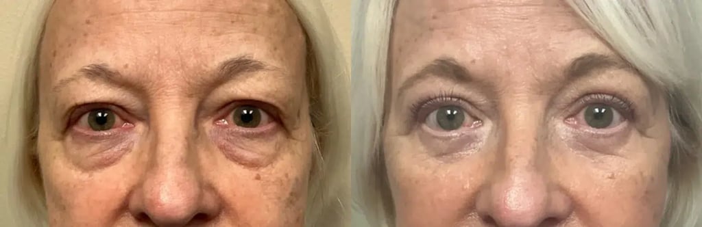 front view eyelid surgery before and after photos by Remington Plastic Surgery DB