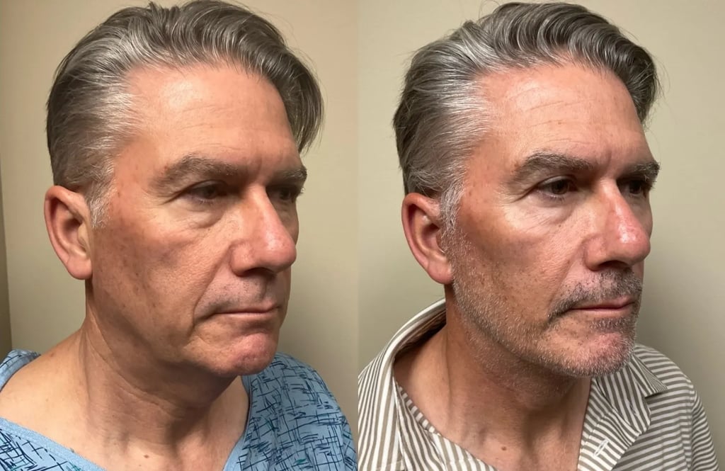 right oblique view facelift before and after photos by Remington Plastic Surgery RJ