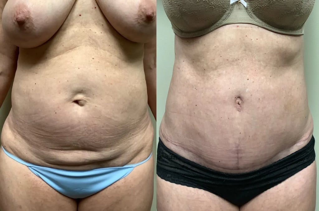 Tummy tuck before and after, front view – Patient 254620 | Remington Plastic Surgery
