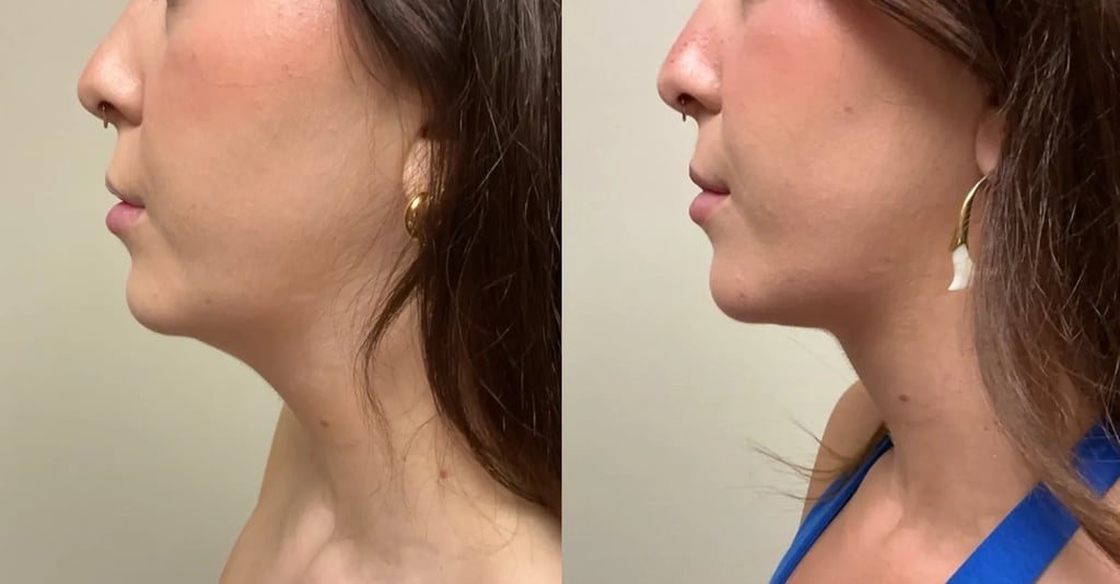 Liposuction before and after, left side view – Patient 254619 | Remington Plastic Surgery