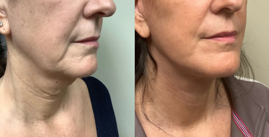 right oblique view face and neck lift before and after photos by Remington Plastic Surgery KF