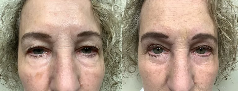 eyelid surgery before and after photos by Remington Plastic Surgery in Kirkland WA